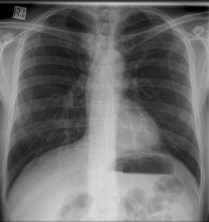 Ejemplo de Radiografía de Torax